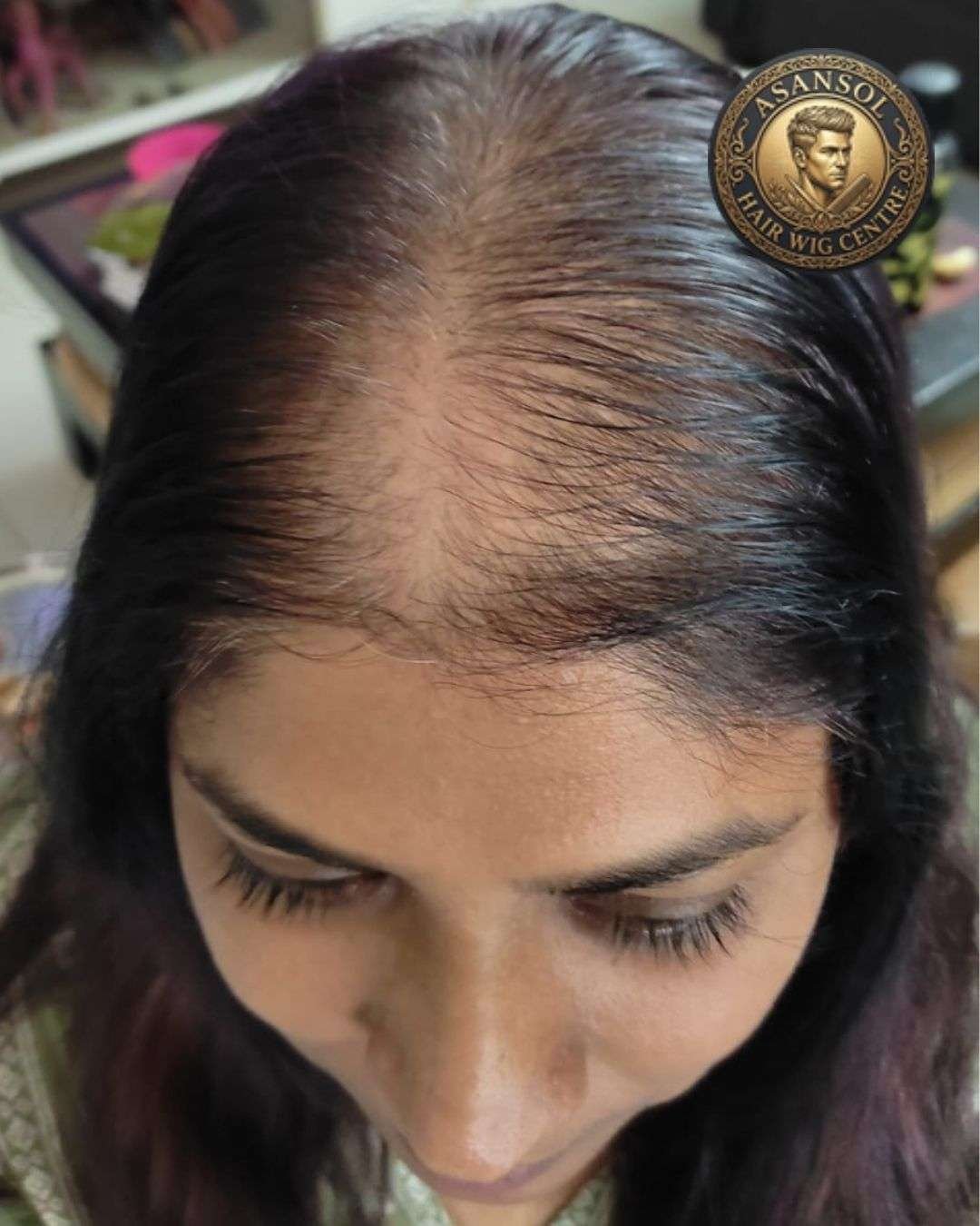 hair-wig-for-men-in-asansol-01 - hair-wig-for-men-in-asansol-22-